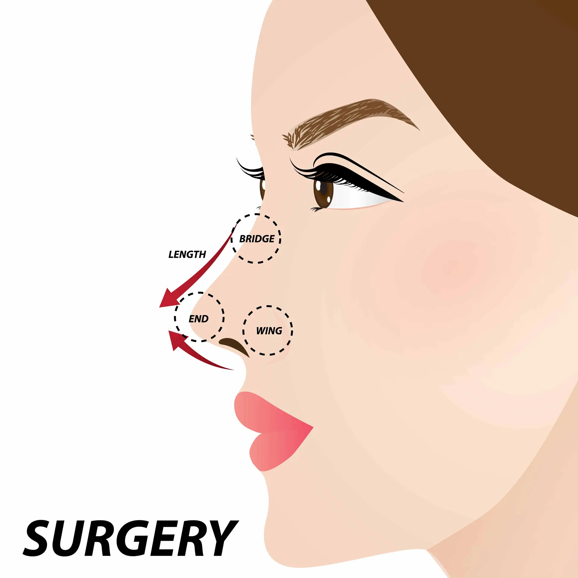 Rhinoplasty