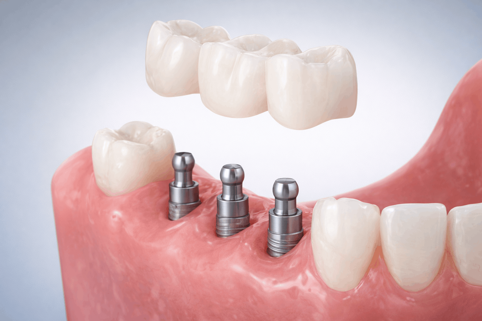 Dental Implants in Armenia: Cost, Procedure, Recovery & Why International Patients Save Up To 70%