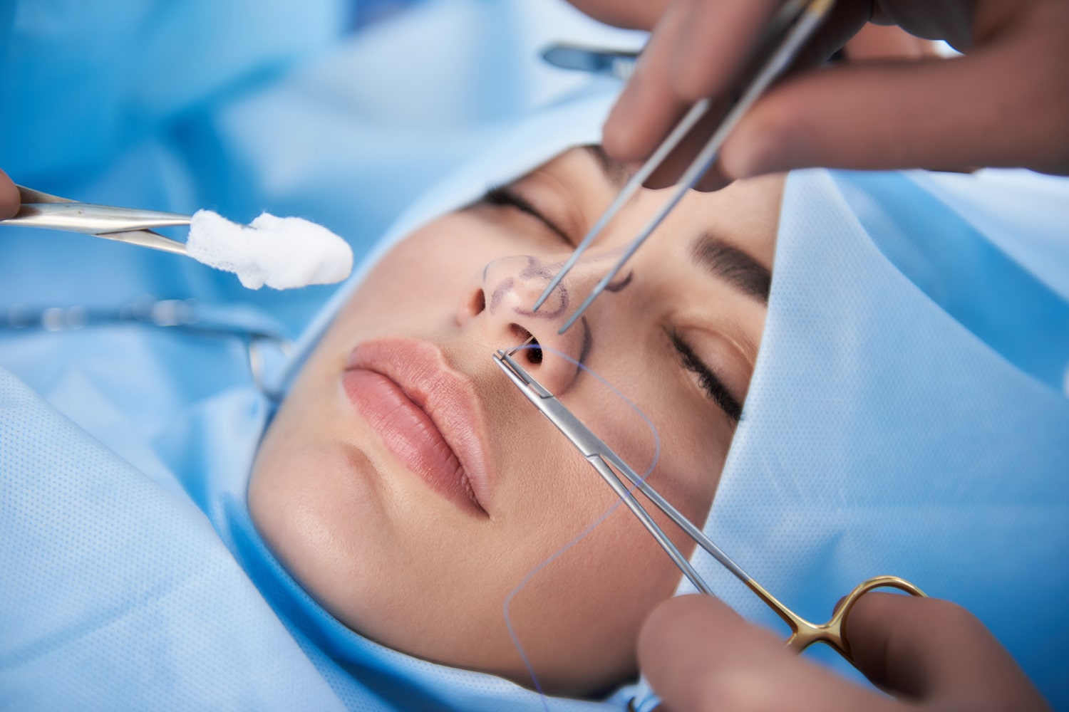 Rhinoplasty in Armenia: What International Patients Should Know
