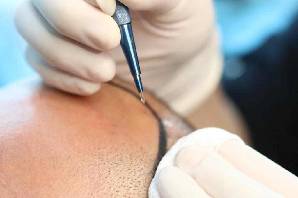 Hair Transplant Cost in Armenia: What International Patients Should Know