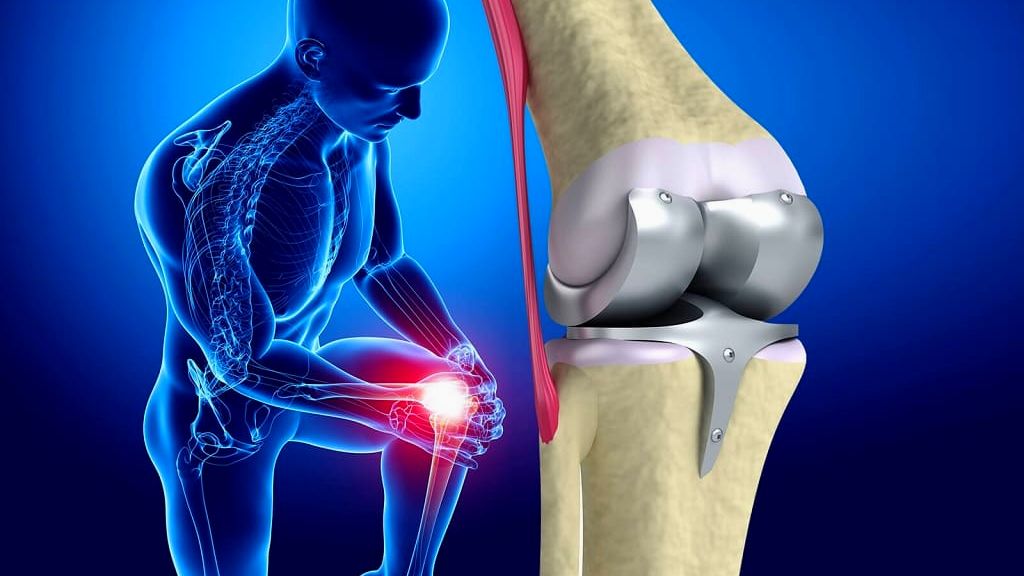 Knee Replacement in Armenia: A Guide for International Patients